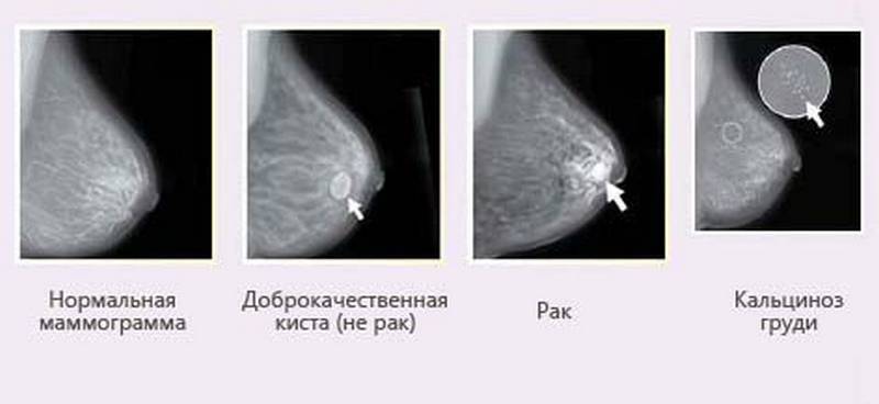 Чем отличается маммография от УЗИ молочных желез?
