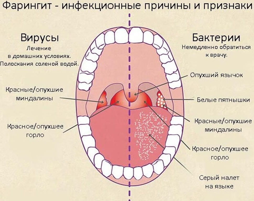 Заболевания горла - фарингит и ларингит: причины, признаки и методика лечения
