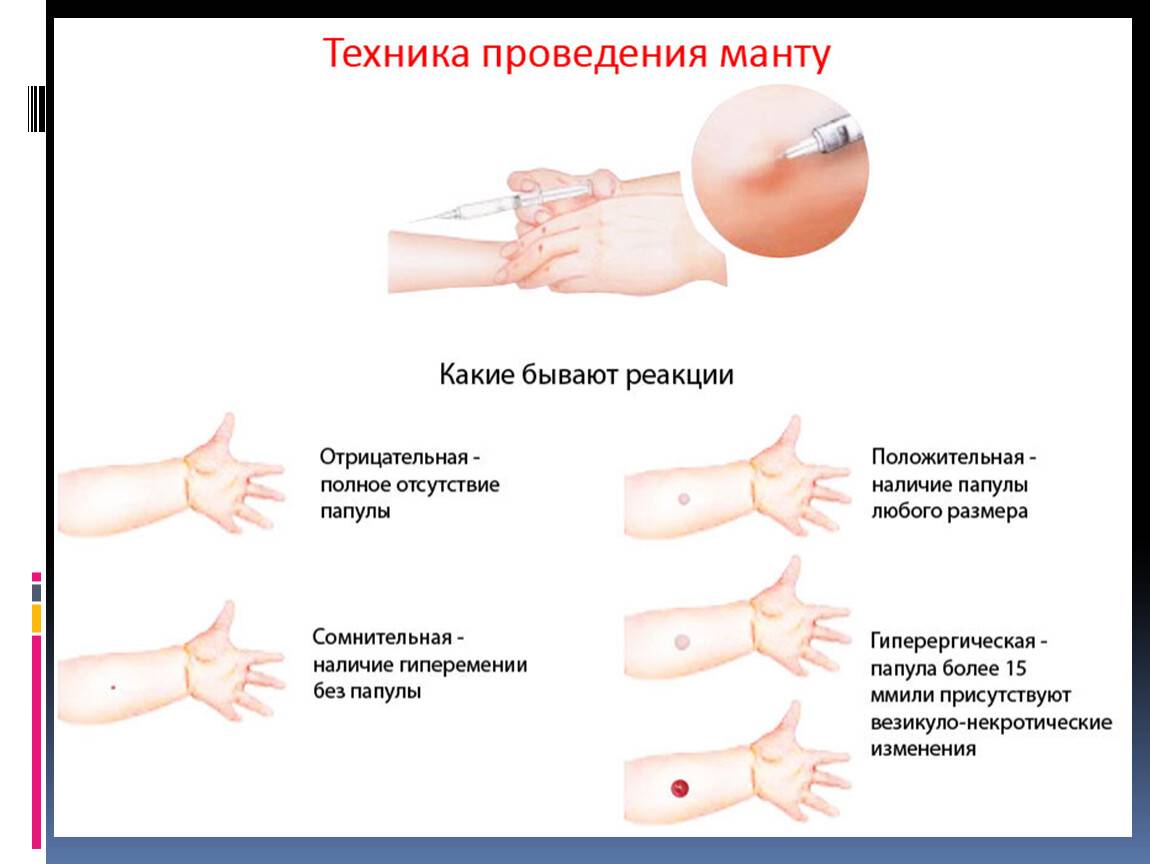 Что лучше и безопаснее: манту или проба диаскинтест