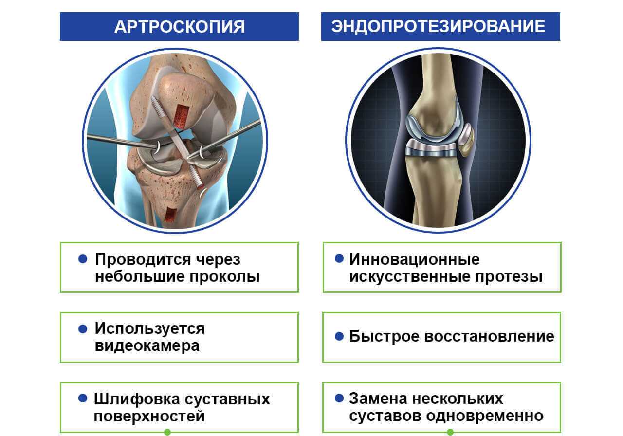 Тонкости диагностики: различаем артроз и артрит