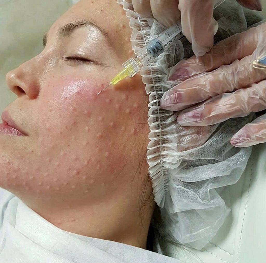 Чем отличается мезотерапия от биоревитализации, что лучше для лица - отличия и в чем разница, ответы косметологов, отзывы