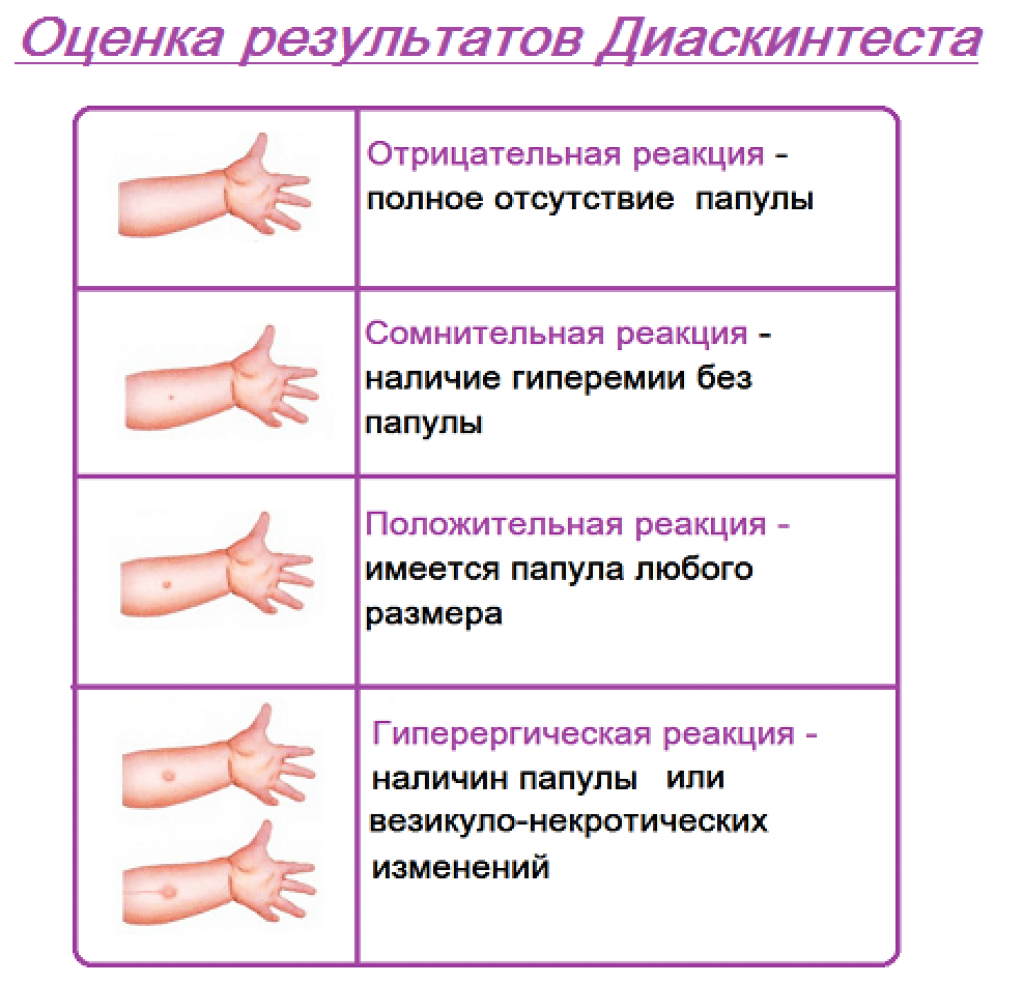 Диаскинтест – что он показывает? показания, побочные эффекты, подготовка и проведение теста ребенку и взрослому, результаты (фото положительной и отрицательной реакции, норма), отзывы. где сделать? сравнение с пробой манту