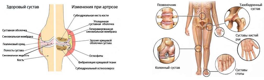 Артрит и артроз: в чем разница, отличия в лечении болезней
