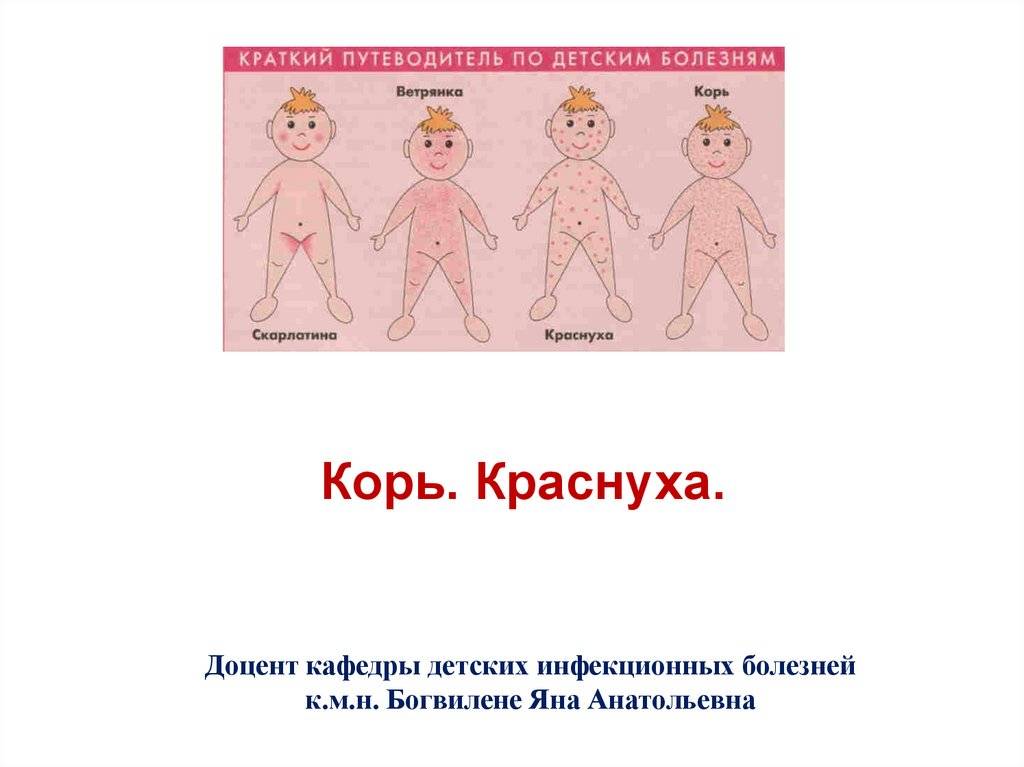 Чем отличается корь от ветрянки