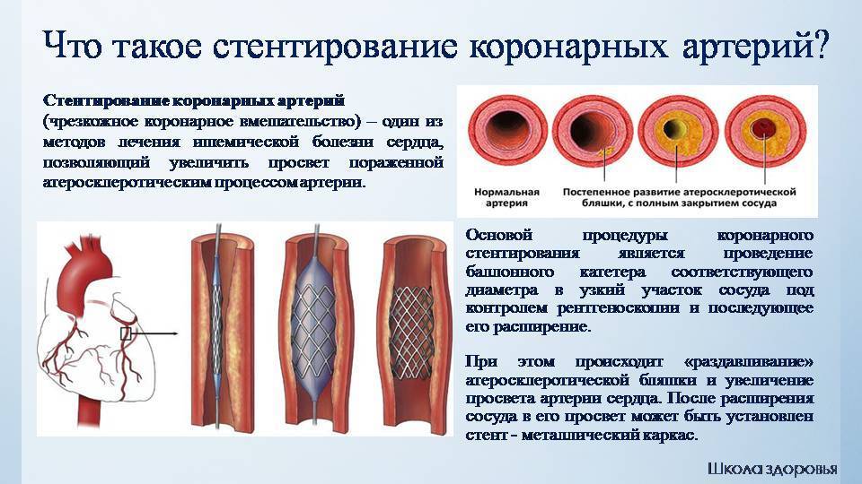 Процесс восстановления после стентирования сосудов сердца: диета, лфк и психологические аспекты