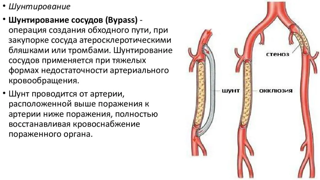 Операция на сонной артерии: когда обязательна, варианты, как проводится, осложнения, реабилитация
