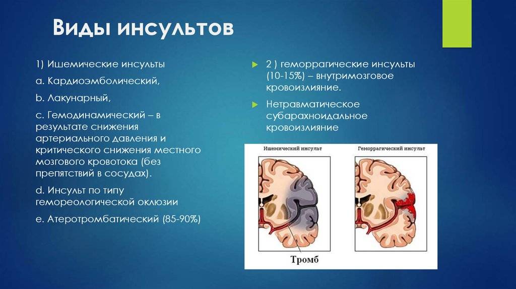 Виды инсультов