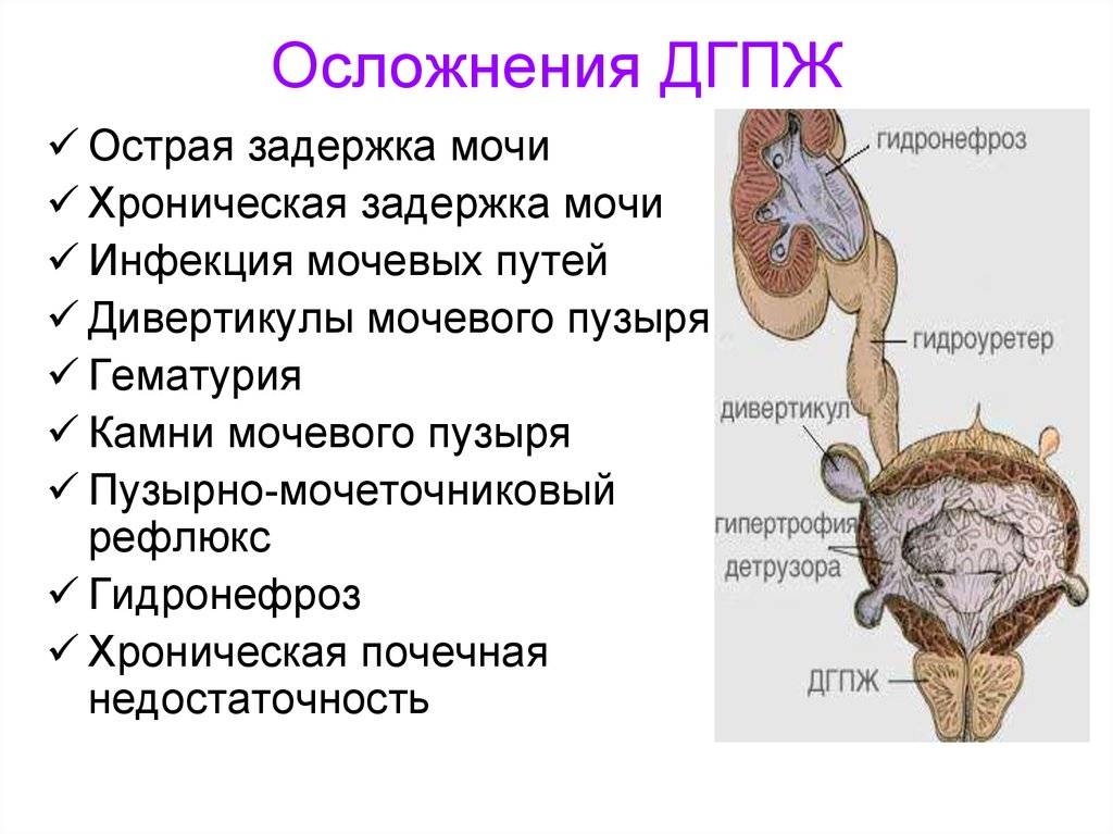 Аденома простаты