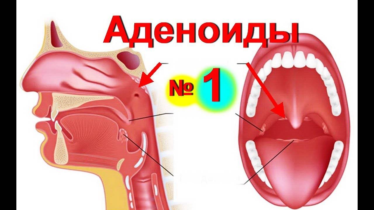 Гланды и миндалины, аденоиды — в чем различия?