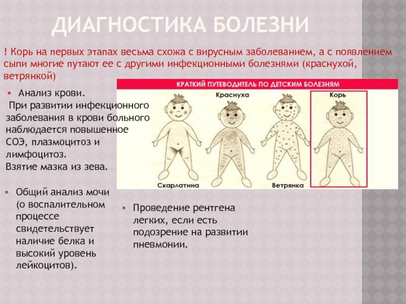 Корь и ветрянка одно и тоже или нет | mfarma.ru