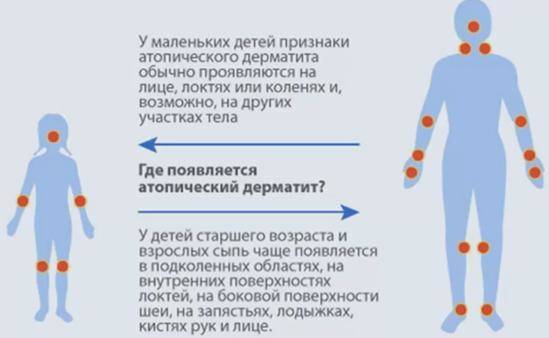 Самые распространенные типы детской аллергии