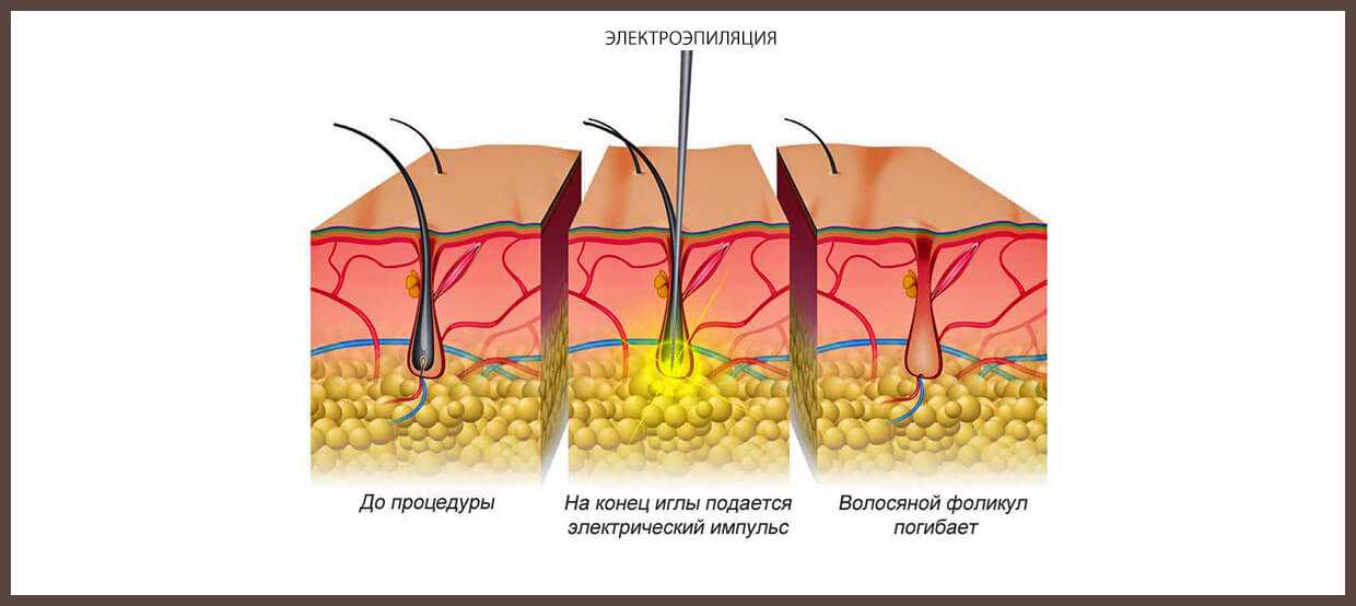 Электроэпиляция: показания, проведения, плюсы и минусы