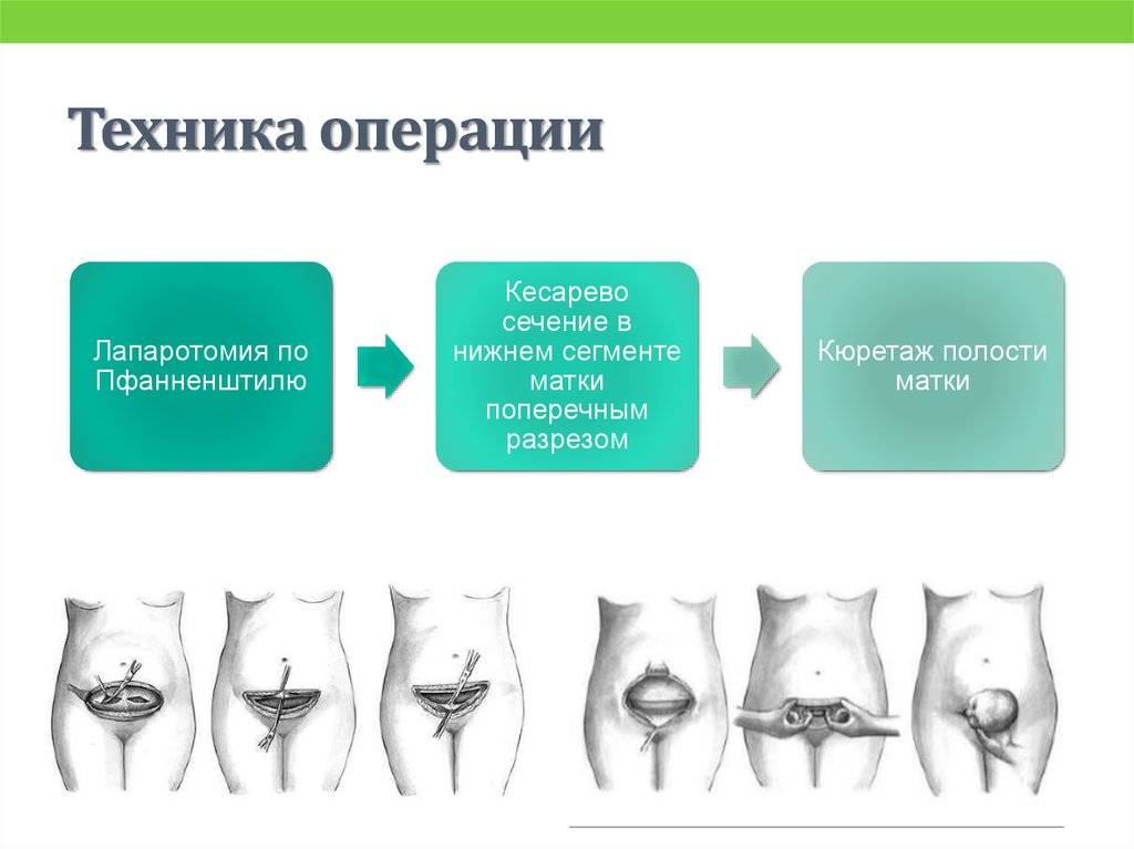 Кесарево сечение: показания, как делают