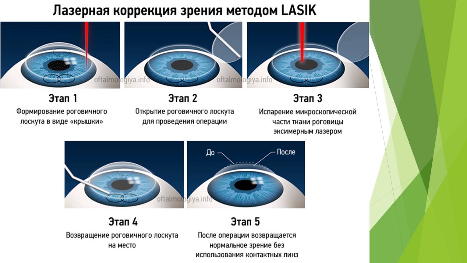 Лазерное лечение катаракты через операцию по удалению хрусталика