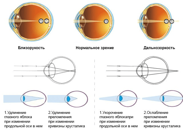 Близорукость и дальнозоркость: в чем разница, что плюс, а что минус?
