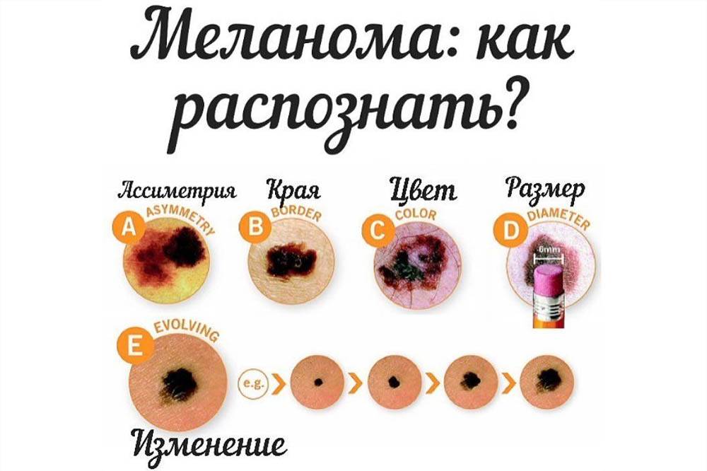 Как отличить родинку от папилломы - сходство и различия наростов