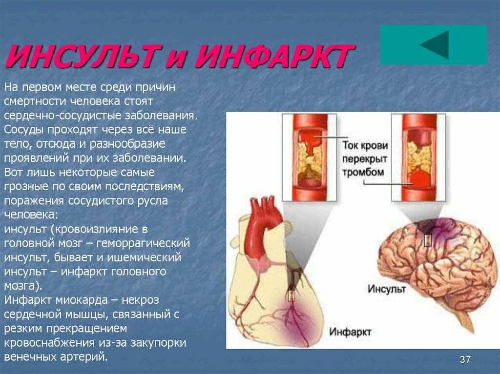 Чем отличается инфаркт от инсульта?