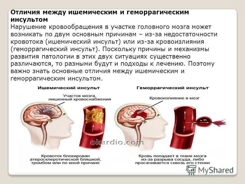 Как предотвратить инсульт головного мозга?