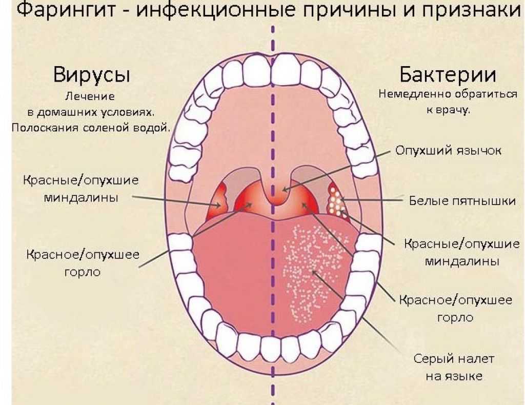Чем фарингит отличается от ангины: описание и отличия