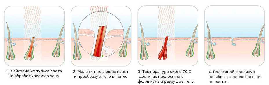Что лучше – электроэпиляция или лазерная эпиляция?