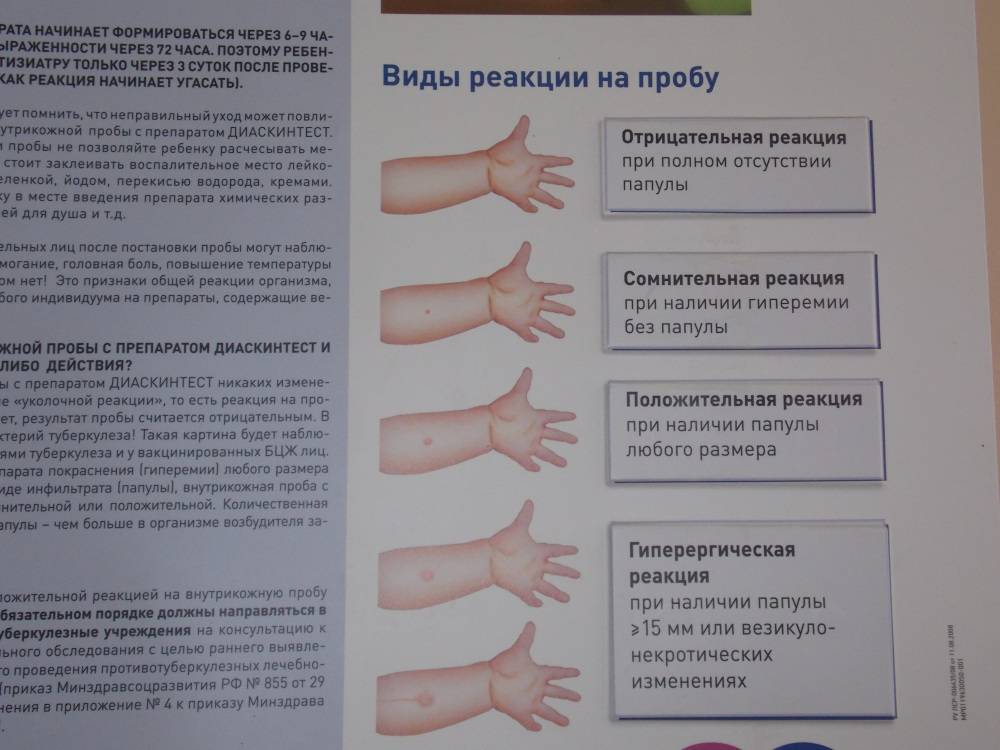Чем отличается проба манту от диаскинтеста: описание и отличия | в чем разница