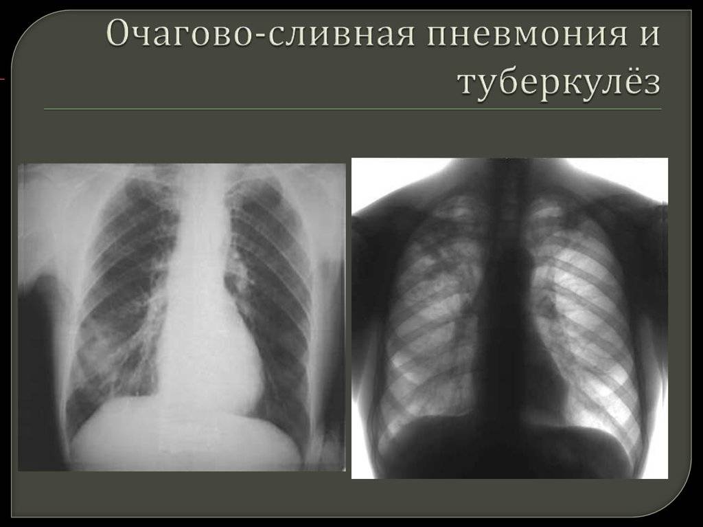 Воспаление легких при туберкулезе: признаки и особенности