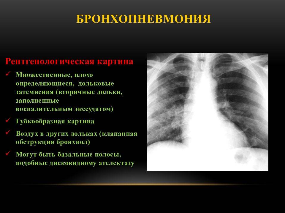 Пневмония: признаки, симптомы, лечение | вирусная пневмония без симптомов