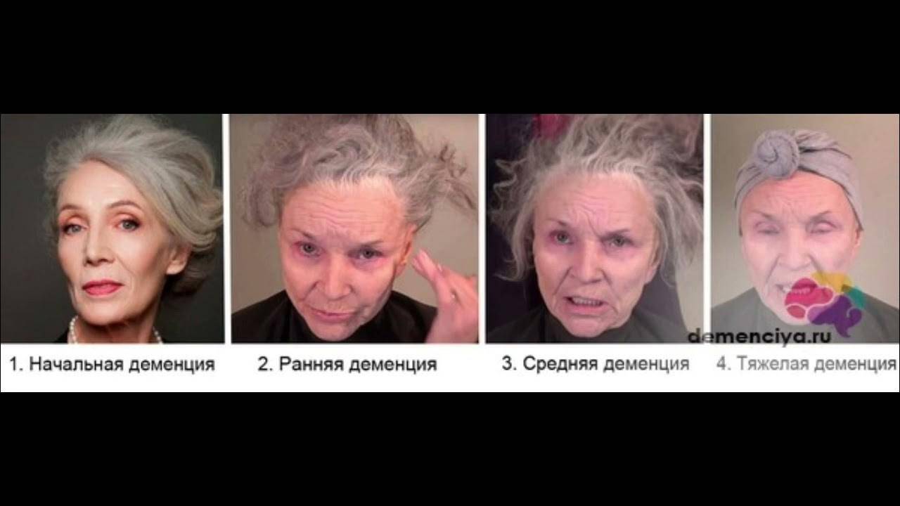 Отличия между деменцией и болезнью альцгеймера