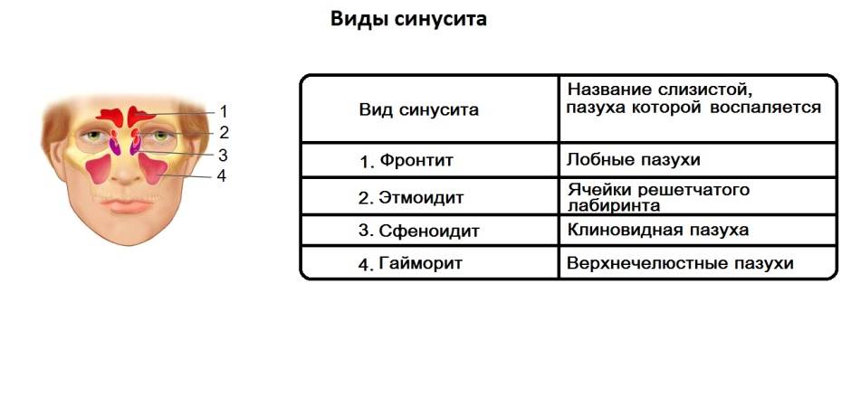 Отличия гайморита и синусита: в чем разница? | za-rozhdenie.ru