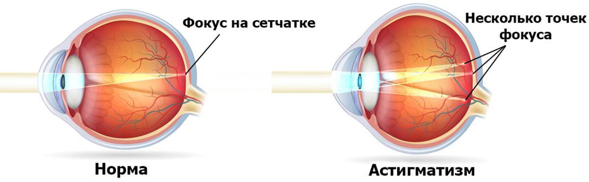 Что такое близорукость и дальнозоркость простыми словами