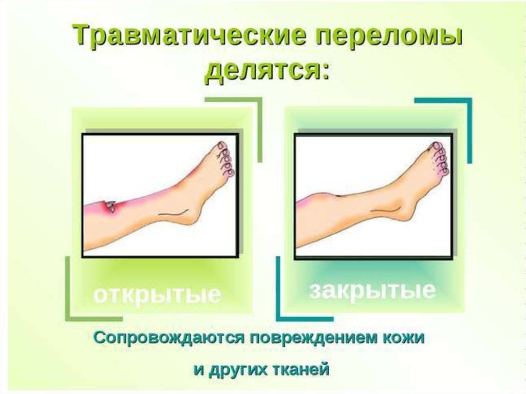Что такое перелом? типы и признаки перелома.