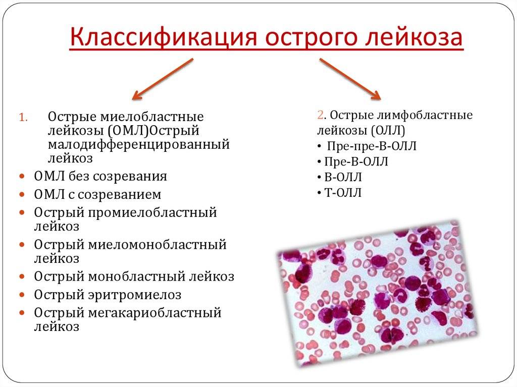Лейкоз у детей: симптомы, диагностика и лечение