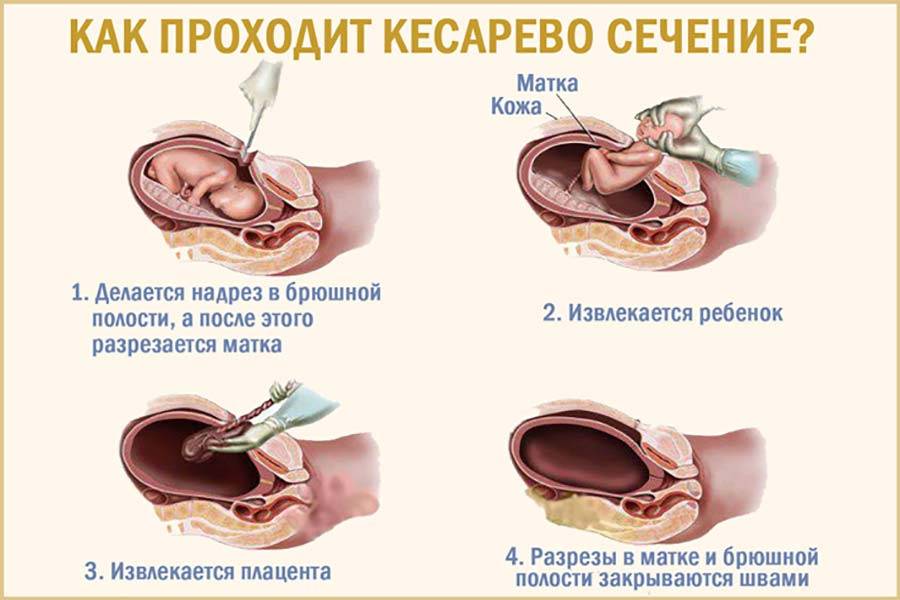Что лучше кесарево или естественные роды - плюсы и минусы