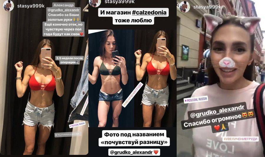 Какой имплант выбрать: круглый или анатомический? - dr.koen
