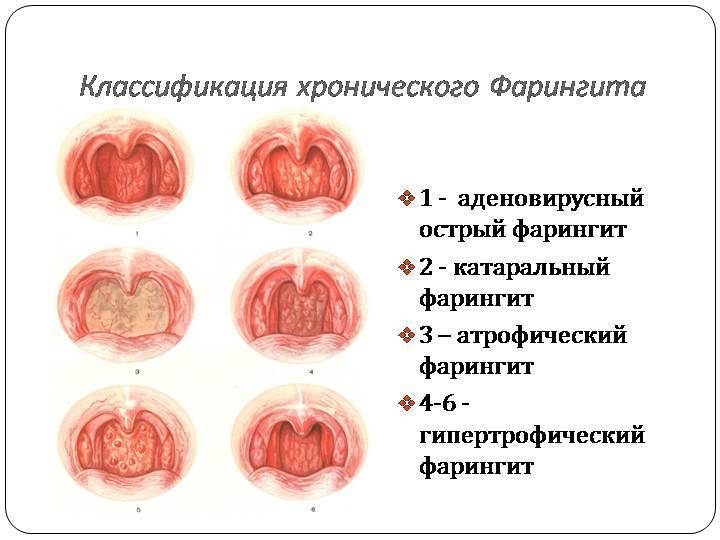 Что такое фарингит. вирусный и бактериальный фарингит