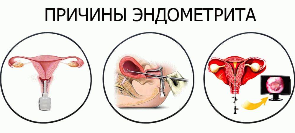 Эндометриоз у женщин: что это, причины, симптомы и лечение