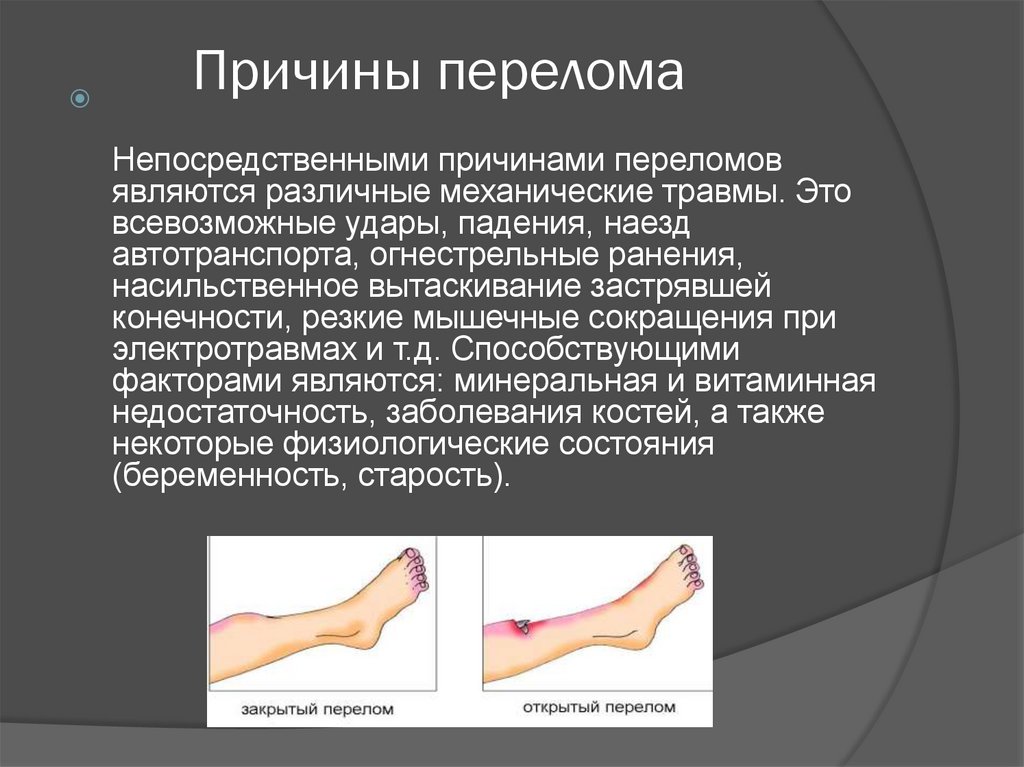 Лечение переломов