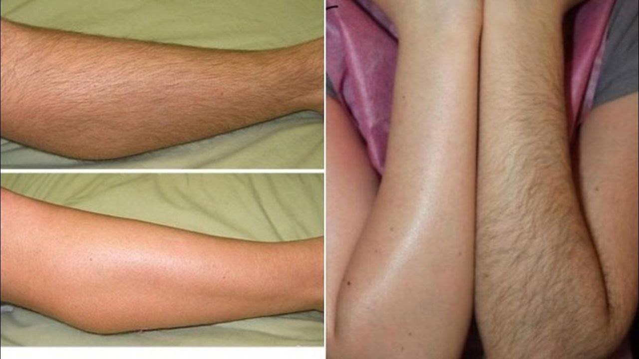 Фотоэпиляция или лазерная эпиляция что лучше: сравнение методов