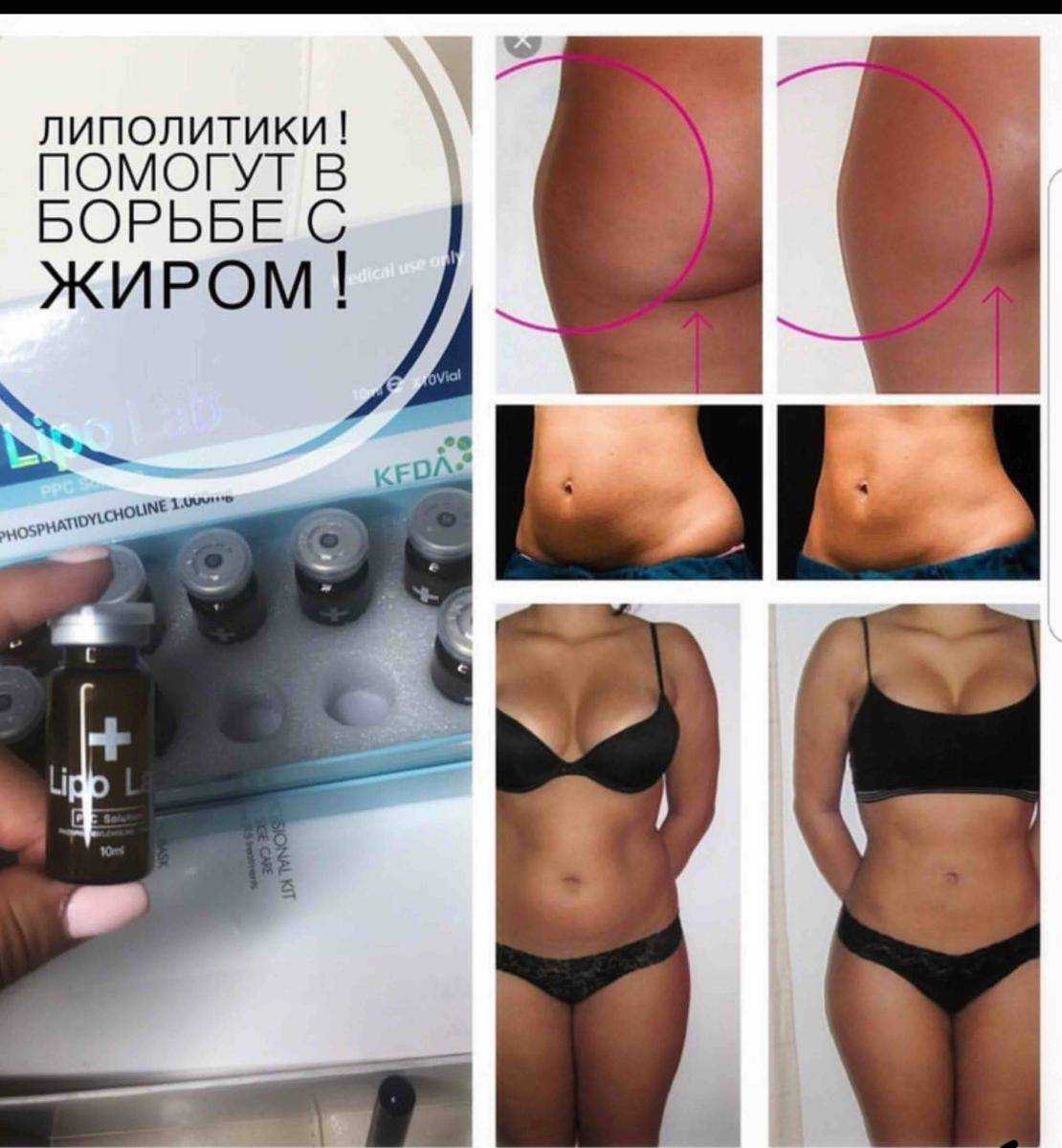 Что такое инъекции липолитиков для похудения? есть ли вред?