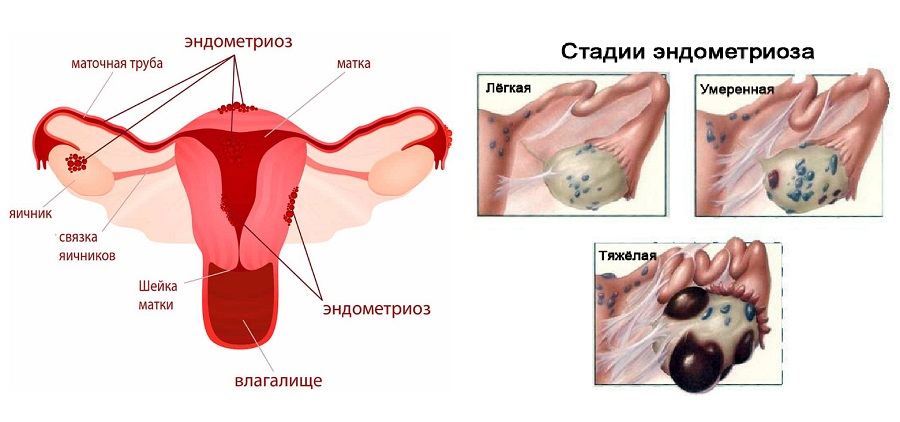 Разница между эндометритом и эндометриозом или это одно и то же