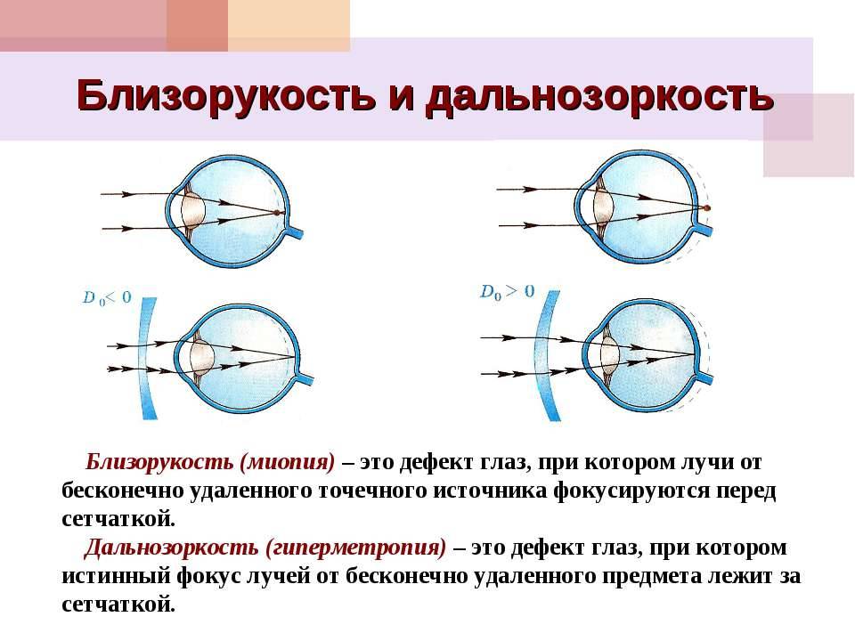 Близорукость и дальнозоркость — в чем разница между нарушениями зрения