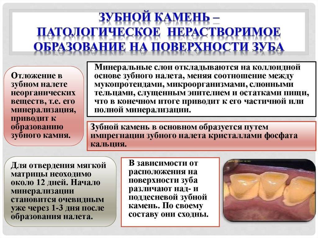 Виды зубных отложений