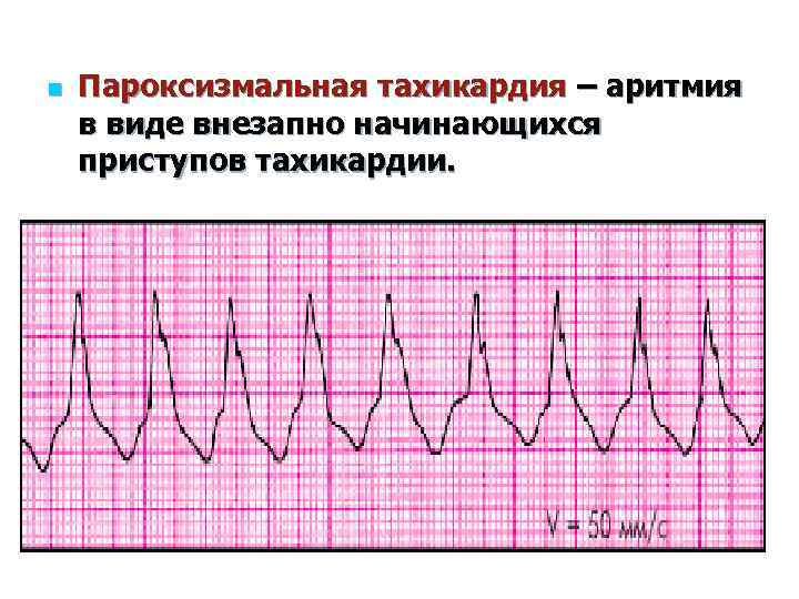 Что хуже аритмия или тахикардия. в чем различия между тахикардией и аритмией? симптоматика проявления аритмии