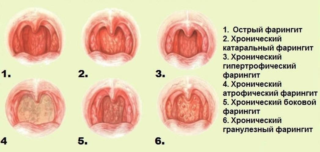 Чем отличаются симптомы тонзиллита, фарингита и ларингита