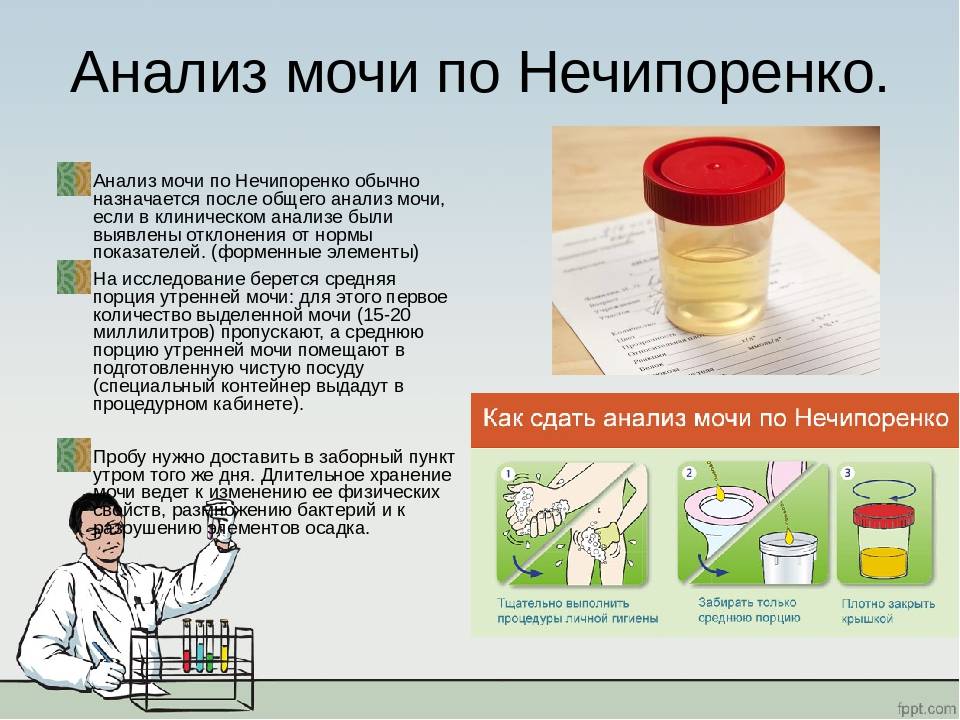 Особенности сбора мочи и расшифровки результатов анализа по методу нечипоренко