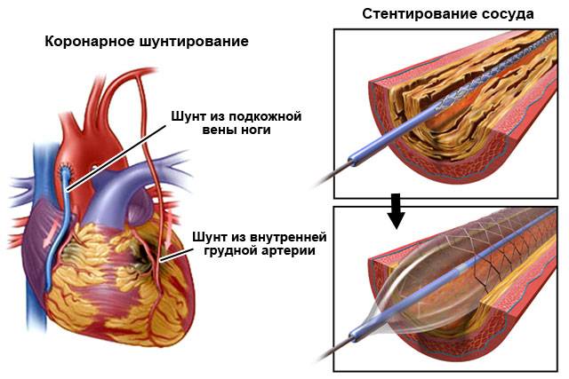 Шунтирование и стентирование сосудов сердца – в чем разница, что лучше и когда делают | стоматология-элит.рф