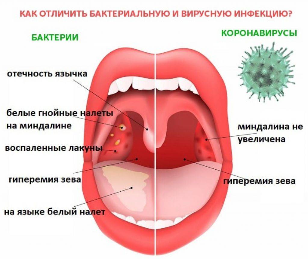 Чем отличаются симптомы тонзиллита, фарингита и ларингита
