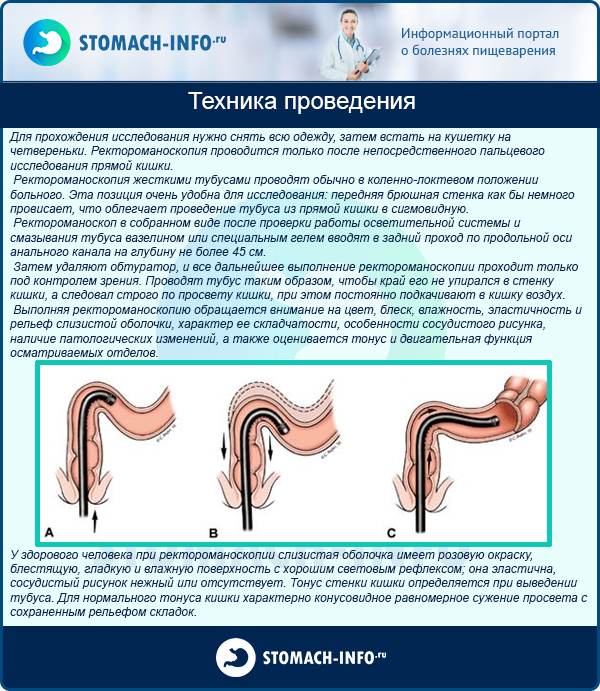 Ректороманоскопия и колоноскопия отличия