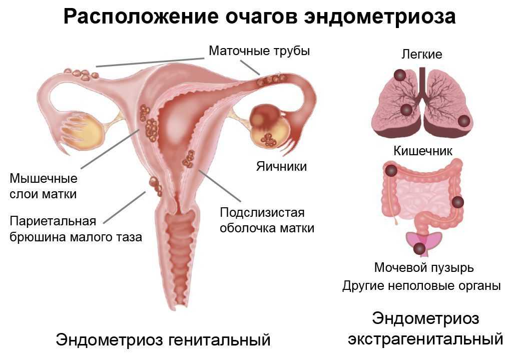 Аденомиоз и эндометриоз: в чем разница, чем отличаются, что хуже, лечение