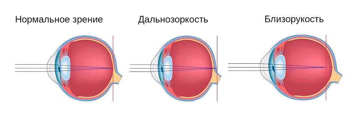 Близорукость — это плюс или минус. чем отличается близорукость от дальнезоркости?